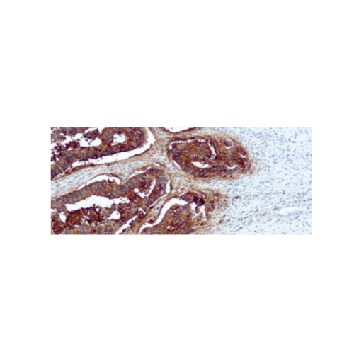 Antígeno Carcinoembrionario (CEA)