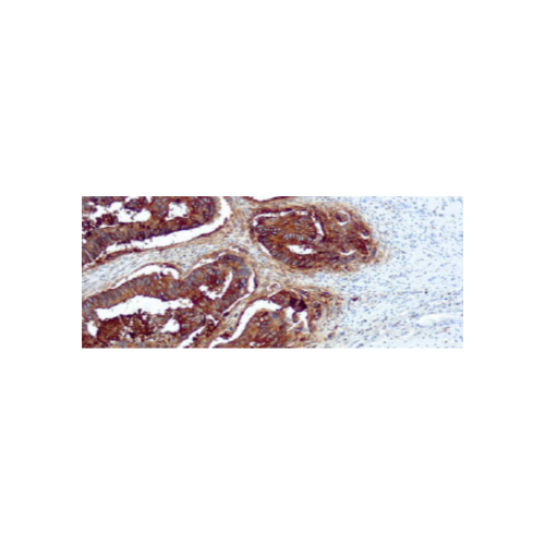 Antígeno Carcinoembrionario (CEA) Antígeno Carcinoembrionario (CEA)