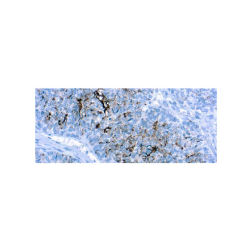 CA125