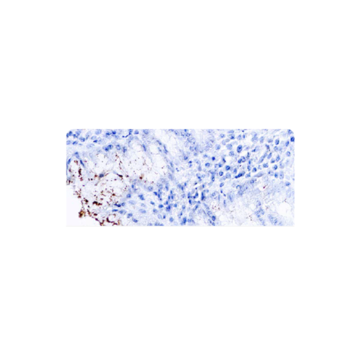 Helicobacter pylori