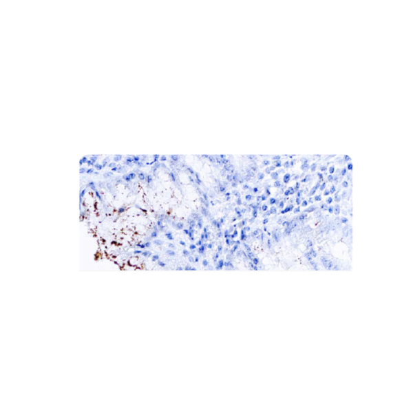 Helicobacter pylori Helicobacter pylori