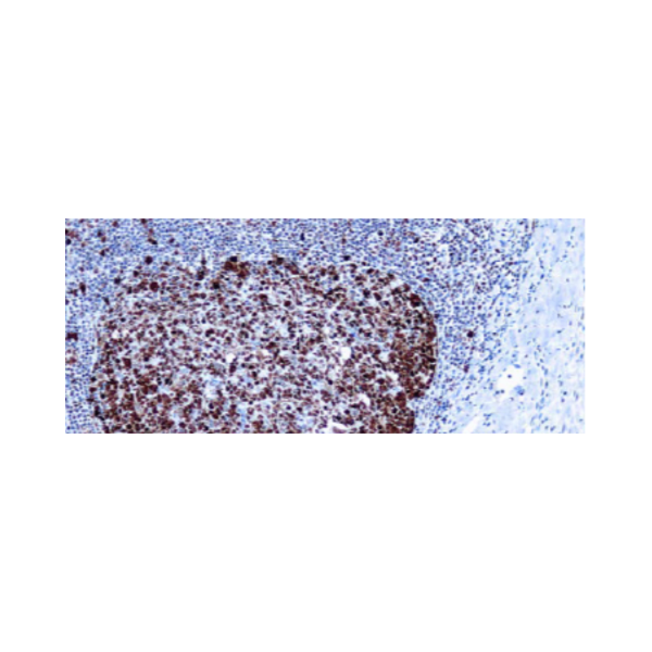 Proliferating Cell Nuclear Antigen (PCNA) (PC10) Proliferating Cell Nuclear Antigen (PCNA) (PC10)