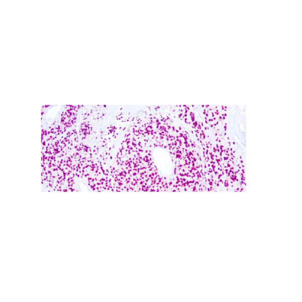 SOX 10 MELANOMA MAKER