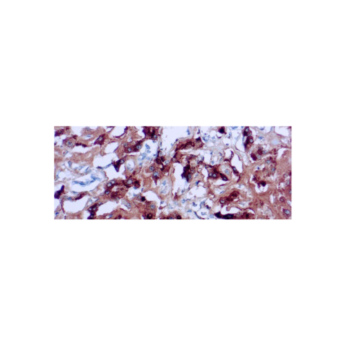 Amiloide A Componente Amiloide A Componente
