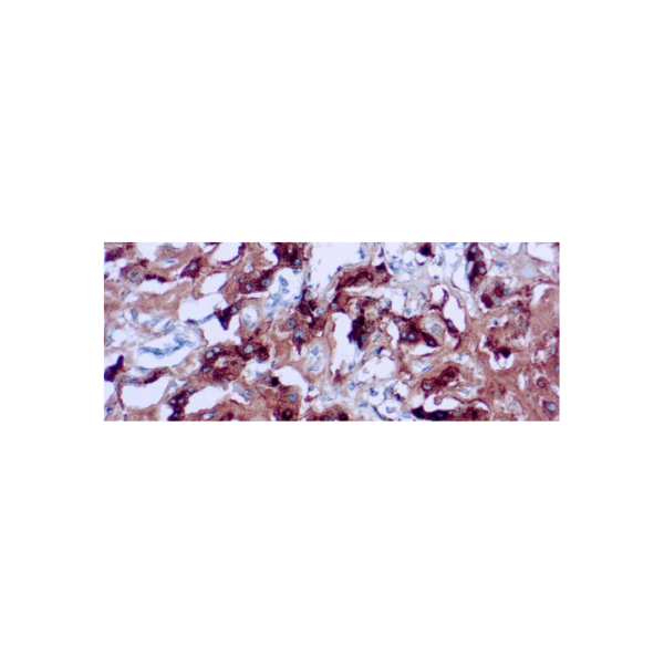 Amiloide A Componente Amiloide A Componente