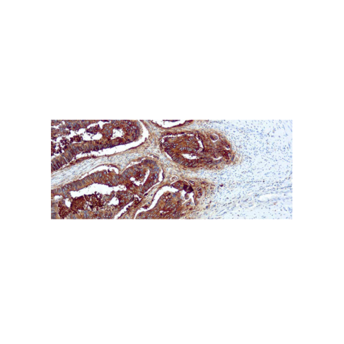 Antigeno Carcinoembrion Antigeno Carcinoembrion