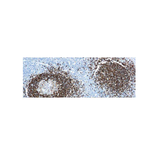 Leucemia de células peludas Leucemia de células peludas