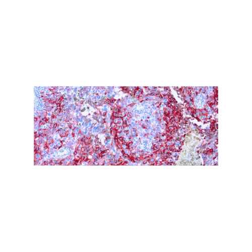 Melanoma (HMB45)