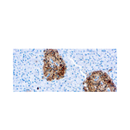 Neurona Especifica Enolasa (NSE) Neurona Especifica Enolasa (NSE)