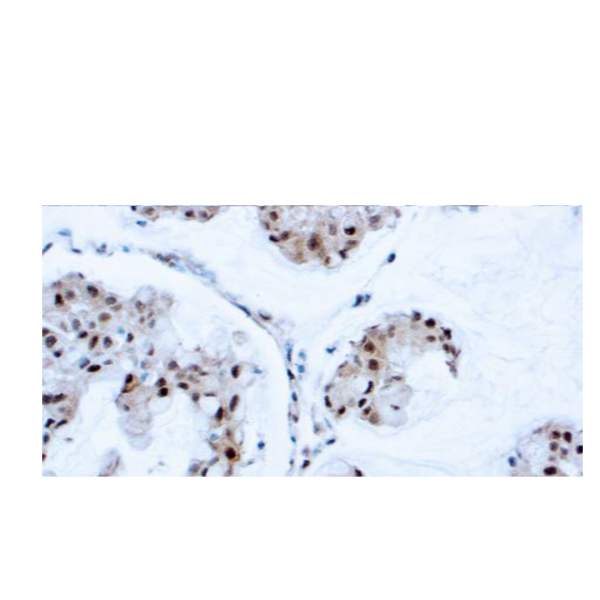 PTEN (Tumor Suppressor) PTEN (Tumor Suppressor)