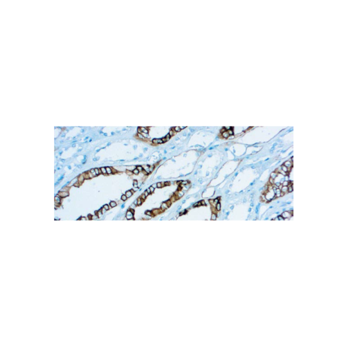 Renal Cell Carcinoma (gp200) Renal Cell Carcinoma (gp200)
