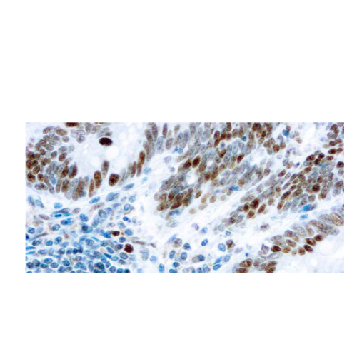 Retinoblastoma
