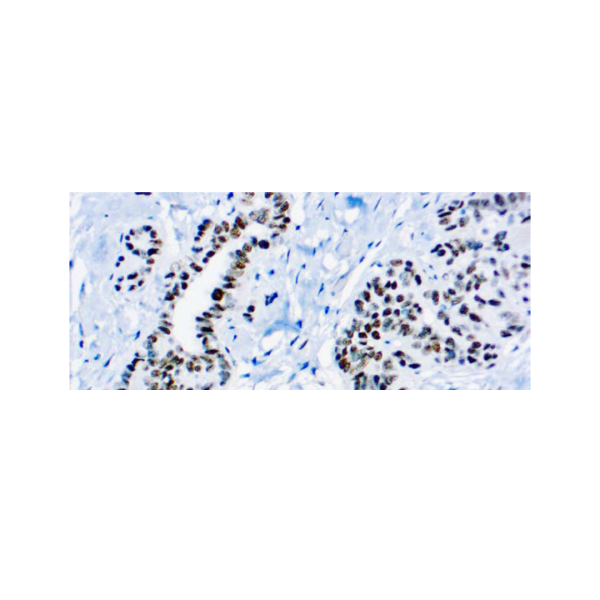 Wilm’s Tumor 1, WT1 Wilm’s Tumor 1, WT1